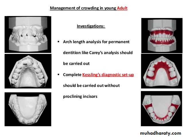 dental crowding and spacing