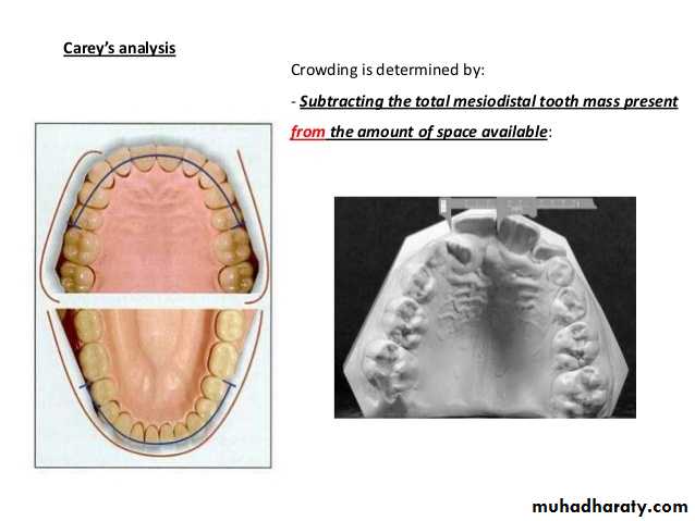 dental crowding and spacing