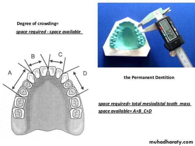 dental crowding and spacing