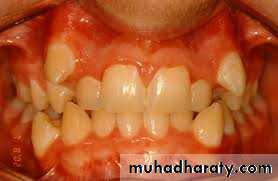 dental crowding and spacing