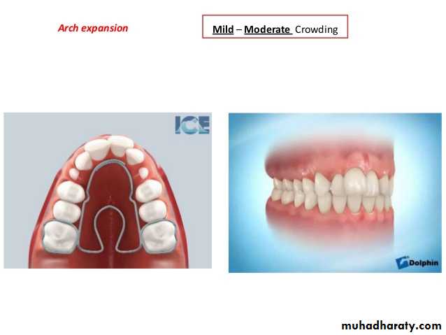 dental crowding and spacing