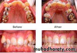 dental crowding and spacing