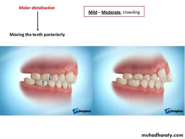 dental crowding and spacing