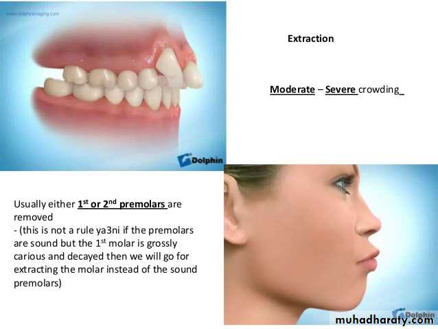 dental crowding and spacing