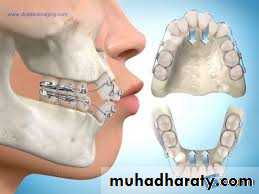 dental crowding and spacing