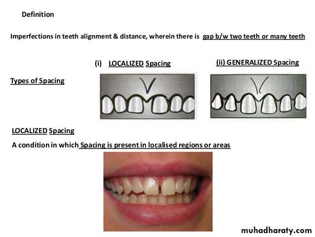 dental crowding and spacing