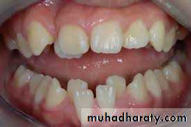dental crowding and spacing