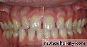 dental crowding and spacing