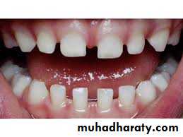dental crowding and spacing