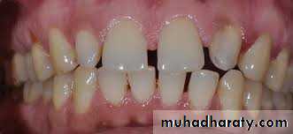 dental crowding and spacing