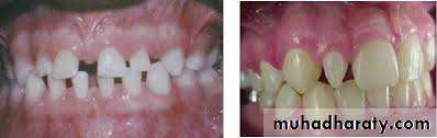 dental crowding and spacing