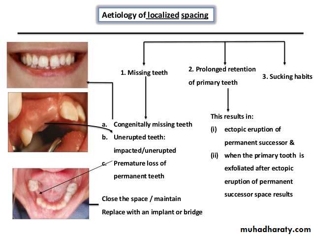 dental crowding and spacing