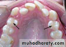 dental crowding and spacing