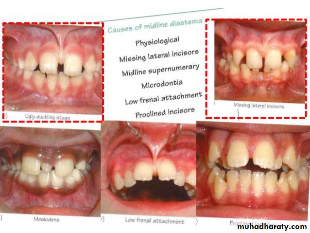 dental crowding and spacing