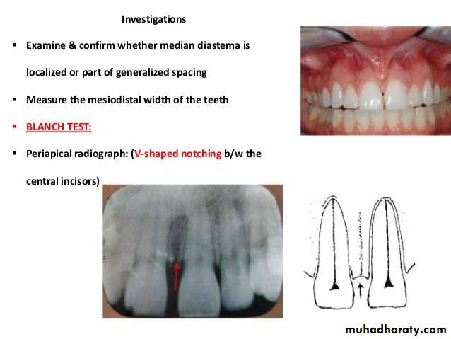 dental crowding and spacing