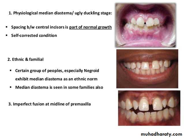 dental crowding and spacing