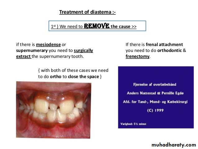 dental crowding and spacing