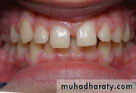 dental crowding and spacing