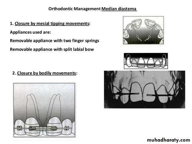 dental crowding and spacing