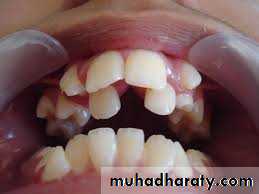 dental crowding and spacing