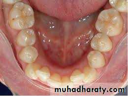 dental crowding and spacing