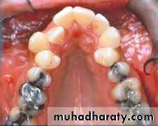 dental crowding and spacing