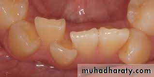 dental crowding and spacing