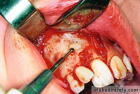 surgical aid to orthodonatic