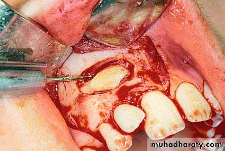 surgical aid to orthodonatic