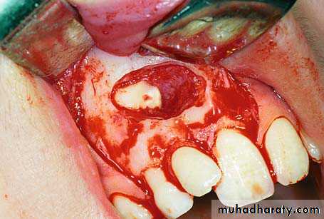surgical aid to orthodonatic