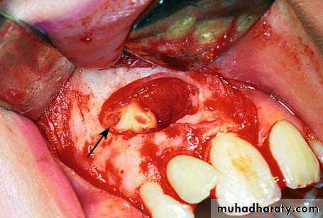 surgical aid to orthodonatic