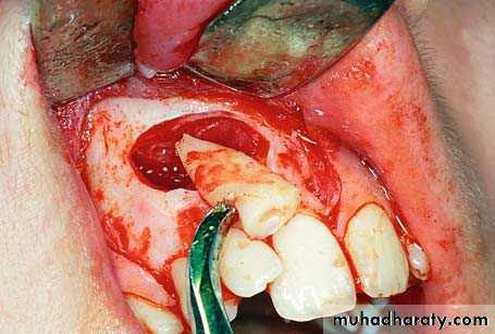 surgical aid to orthodonatic