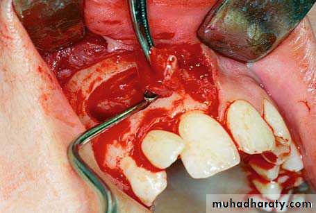 surgical aid to orthodonatic