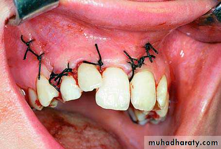 surgical aid to orthodonatic