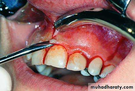 surgical aid to orthodonatic