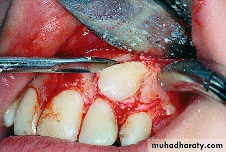 surgical aid to orthodonatic