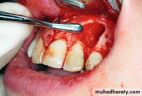 surgical aid to orthodonatic