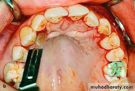 surgical aid to orthodonatic