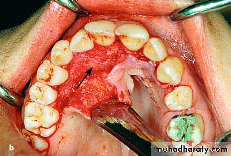 surgical aid to orthodonatic