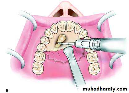 surgical aid to orthodonatic