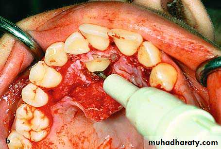 surgical aid to orthodonatic