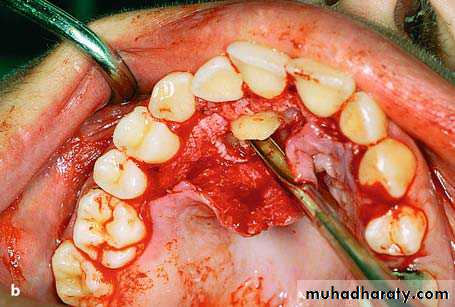 surgical aid to orthodonatic