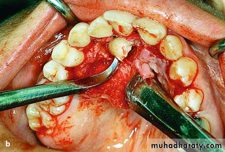 surgical aid to orthodonatic