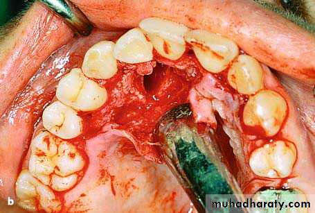 surgical aid to orthodonatic