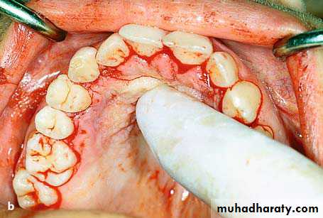 surgical aid to orthodonatic