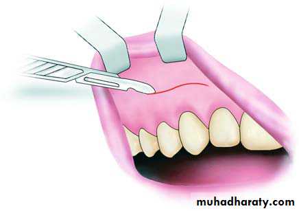 surgical aid to orthodonatic