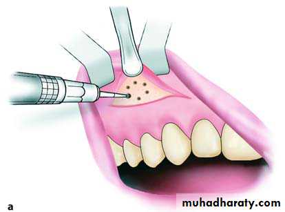 surgical aid to orthodonatic