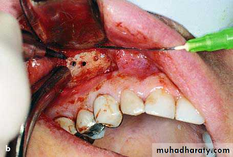 surgical aid to orthodonatic