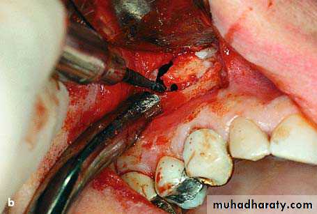 surgical aid to orthodonatic