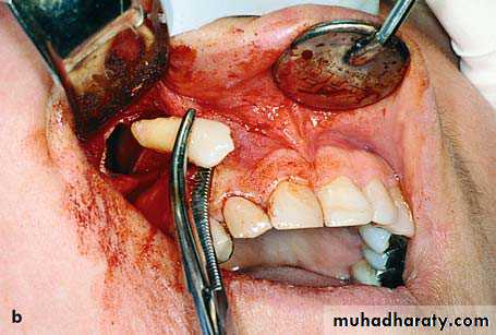 surgical aid to orthodonatic